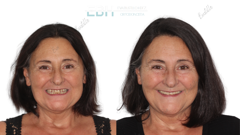 Espacios entre dientes ( diastemas ). Ortodoncia en Adultos.