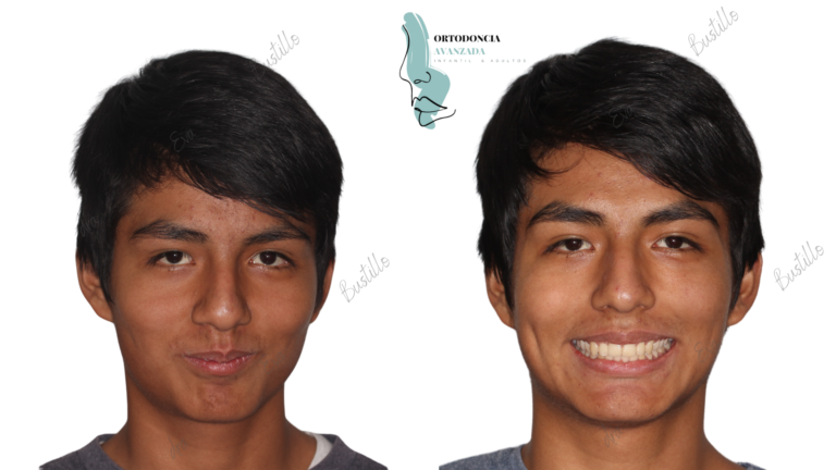 Apiñamiento Severo y Clase II . Ortodoncia en Adolescentes .