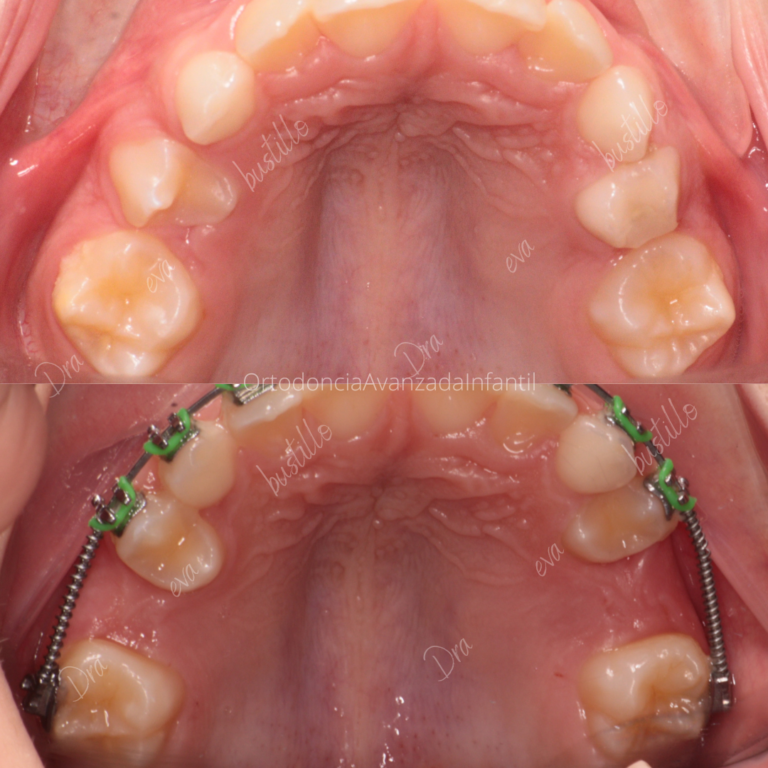 Falta espacio dentición Mixta . Ortodoncia Infantil.