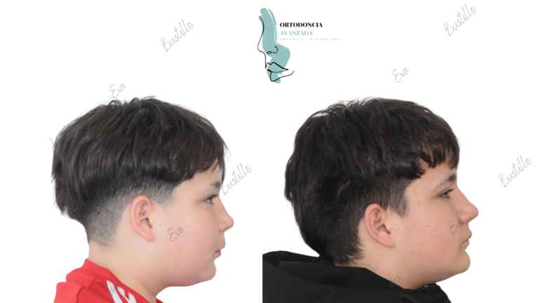 Avance mandibular. Ortodoncia Infantil .